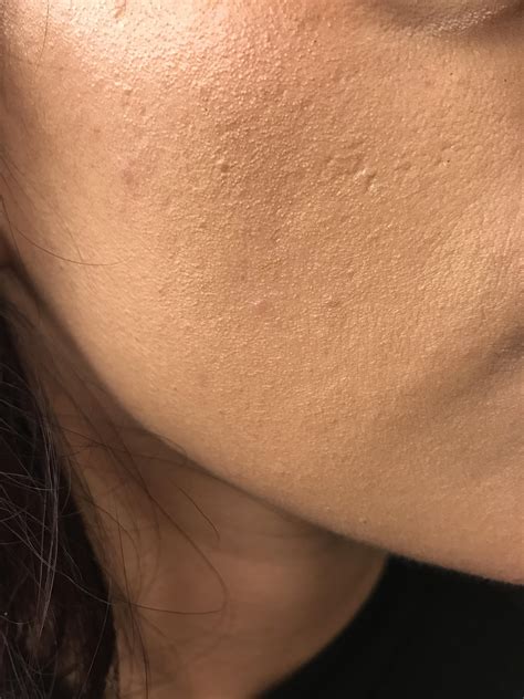 Small Micro Skin Bumps On Cheeks Any Idea General Acne Discussion