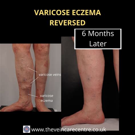 Varicose Eczema The Veincare Centre