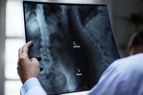 Przyczyny Objawy I Leczenie Osteoporozy