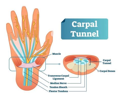 Carpal Tunnel Syndrome The Most Common Office Related Injury All