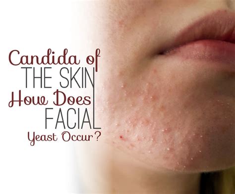 Skin Care Tagged Home Remedies To Fight Yeast Infection Of The Face