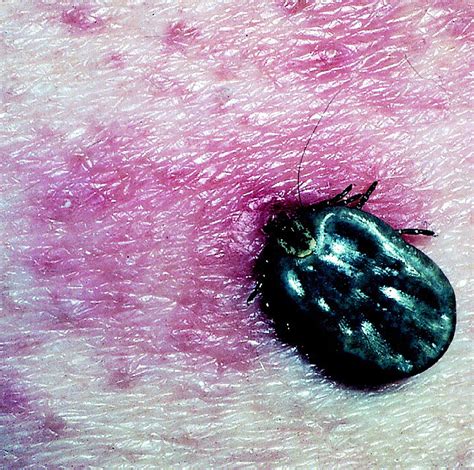 Dermatoses From Ticks Journal Of The American Academy Of Dermatology
