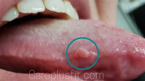 Pimple On Tongue Reno Article