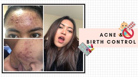 My Acne Story Skincare Routine Minum Pil Kb Jerawat Parah