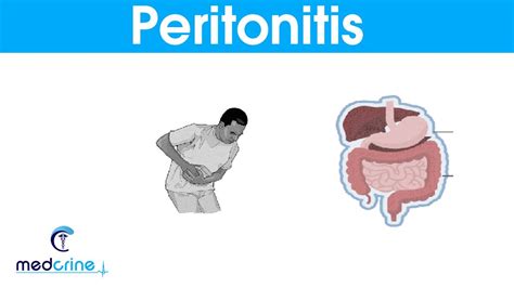 Peritonitis Causes Signs And Symptoms And Treatment Youtube