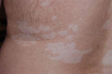 Vitiligo Pictures And Clinical Information