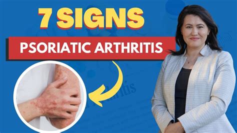 Psoriatic Arthritis 7 Signs And Symptoms A Rheumatologist Review