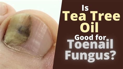 Does Tea Tree Oil Kill Toenail Fungus Is Tea Tree Oil Good For Toenail