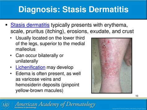 Causes Of Stasis Dermatitis