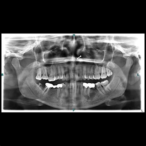 Periapical Cyst