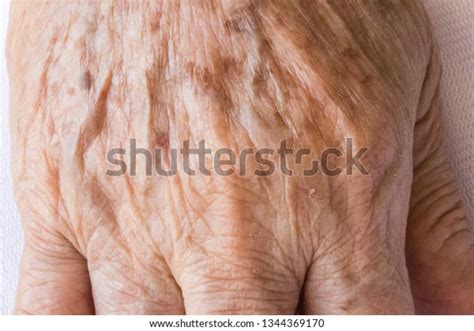Closeup Age Spots Skin Liver Spots Stock Photo Edit Now 1344369170