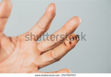 Close Man Hand Sutured Wound On Stock Photo 1967009947 Shutterstock