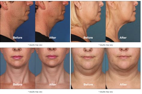 Kybella Injectable For Double Chin Treatment