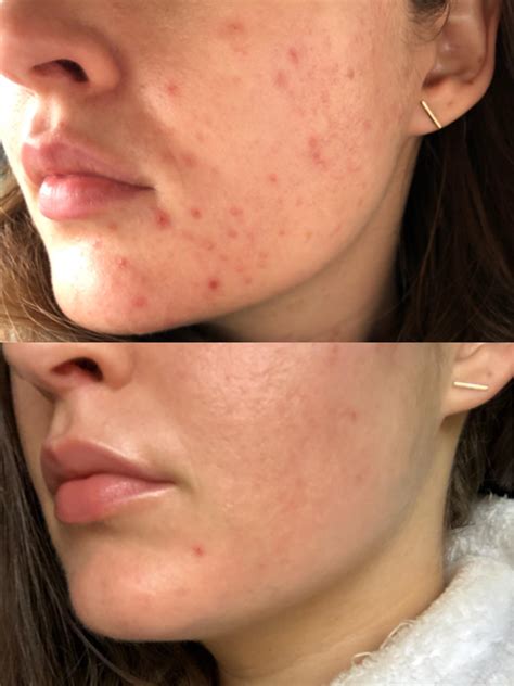 Before You Start Accutane, Read My Story