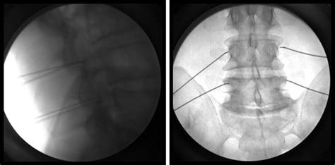Radiofrequency Neurotomy For The Treatment Of Pain In The