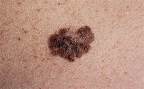 What Is Skin Cancer Melanoma Types Symptoms Causes And Treatment