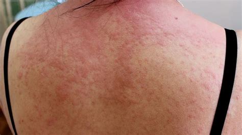 Are Hives On The Breast A Symptom Of Another Health Condition Hives