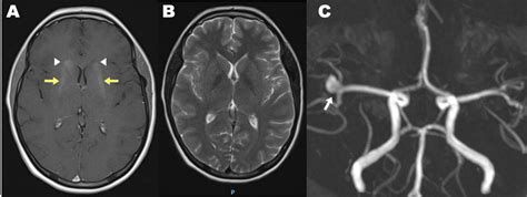 Contrast Enhanced Head Mri A Axial T1 Weighted Bilateral