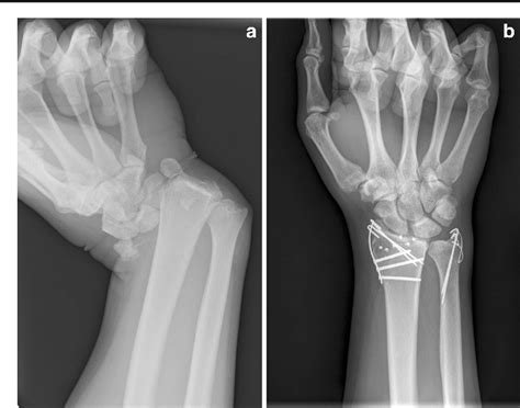 Figure 1 From Outcomes After Radiocarpal Dislocation A Retrospective