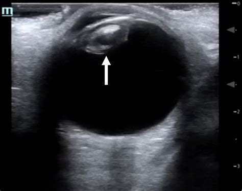 Point Of Care Ultrasound Detection Of Cataract In A Patient With Vision