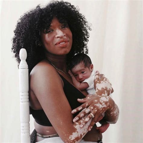 6 Moments Most Parents With Vitiligo Experience Living Dappled