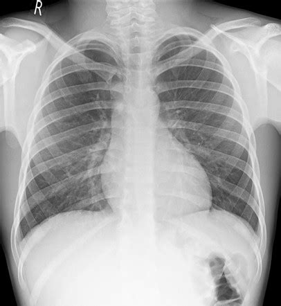 Chest Radiograph Pediatric Radiology Reference Article