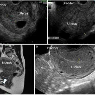 Pdf Incarceration Of Early Gravid Uterus With Adenomyosis And Myoma