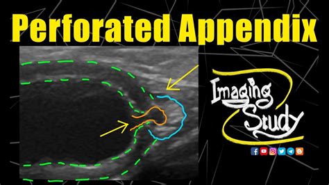 Perforated Vermiform Appendix Ultrasound Case 240 Youtube