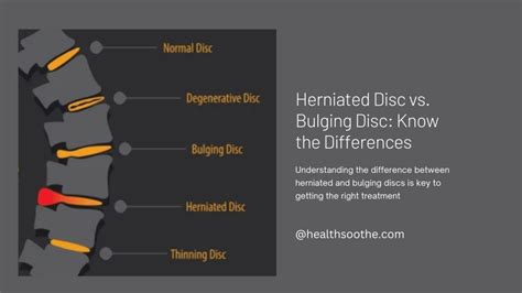 Herniated Disc Vs Bulging Disc Know The Differences
