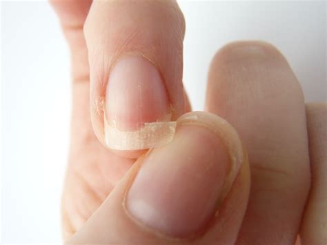 What Vitamin Deficiency Causes Brittle Nails New Health Advisor