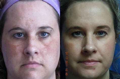 Laser Skin Rejuvenation Before And After Pictures Case 12 Coeur Dalene Id Dr Kevin