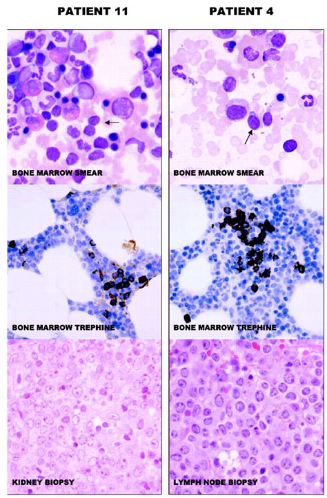 Low Levels Of Monoclonal Small B Cells In The Bone Marrow Of Patients