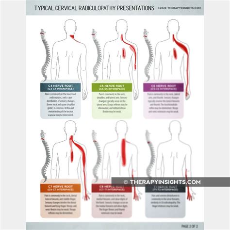 typical cervical radiculopathy presentations printable handouts for porn sex picture