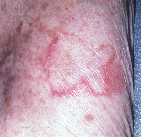 Not All Round Skin Rashes Are Ringworm A Differential Diagnosis Of
