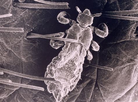Worst case of head lice ever? grim video shows lice ...