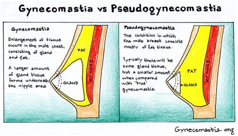 Pseudogynecomastia Surgery Treatment