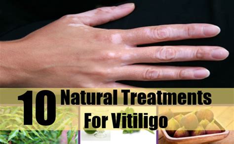 10 Best Vitiligo Home Remedies And Treatments Best Herbal Health
