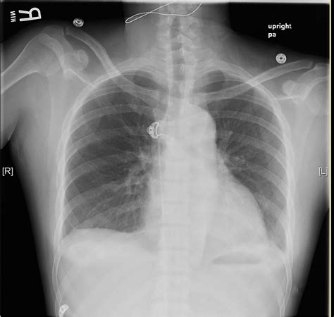 Aortic Dissection X Ray Aortic Dissection Cxr Findings Aortic