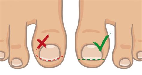 Preventing Ingrown Toenails How To Prevent Ingrown Toenails