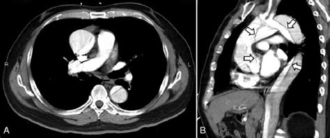 Contrast Enhanced Computed Tomography Of Chest Indicated Type A Aortic