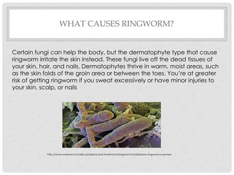 Ppt What Is Ringworm Powerpoint Presentation Id3020046