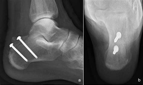 Avulsion Fracture of the Calcaneal Tuberosity: Case Report ...