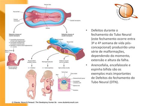 Defeitos Do Tubo Neural
