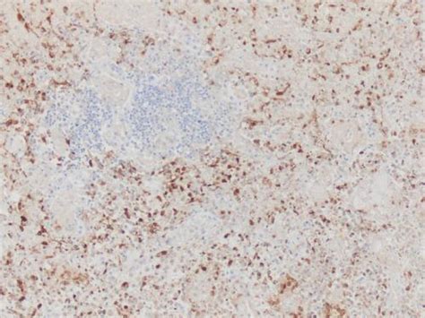 Herpes is separated into two types: Histology Slides HERPES SIMPLEX VIRUS, TYPE I & II (HSV-1 ...