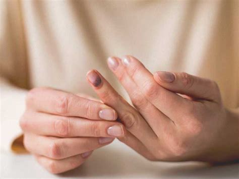 Smashed Finger Treatment Recovery Seeking Help And More