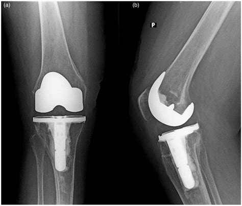 Postoperative Radiographs Of The Right Knee Taken 2 Years After Surgery
