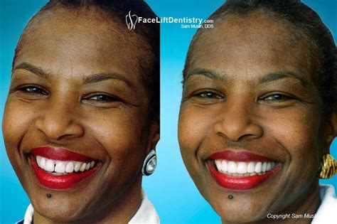 Facelift Dentistry Before And After Photos