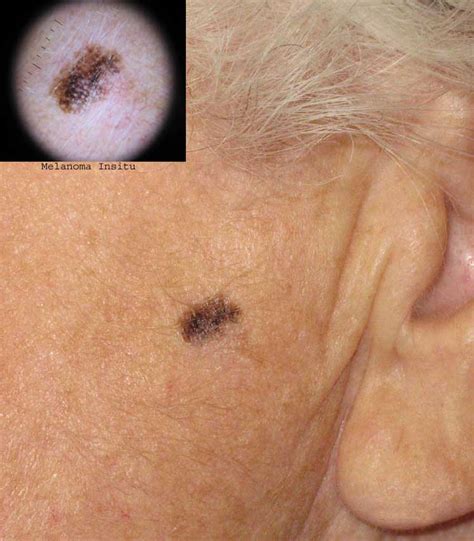Melanoma Insitu Marsden Skin Cancer Clinic