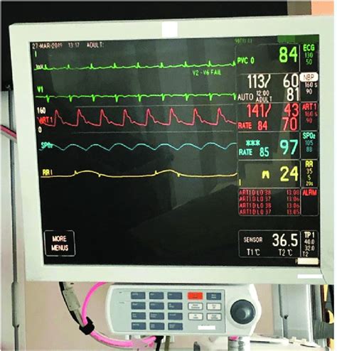 Albums 93 Images What Are The Lines On A Hospital Monitor Excellent