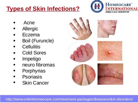 Pictures Of Different Types Of Rashes Pictures Photos